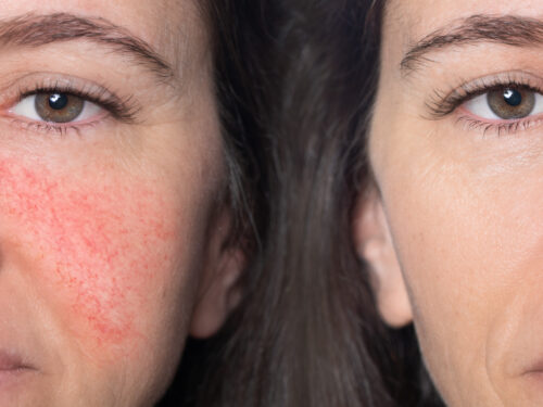 H.Pylori and Rosacea – is a bacterial infection in your stomach causing your Rosacea?